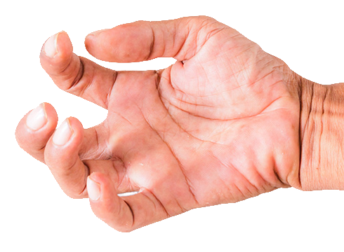 saebo strecth contractura